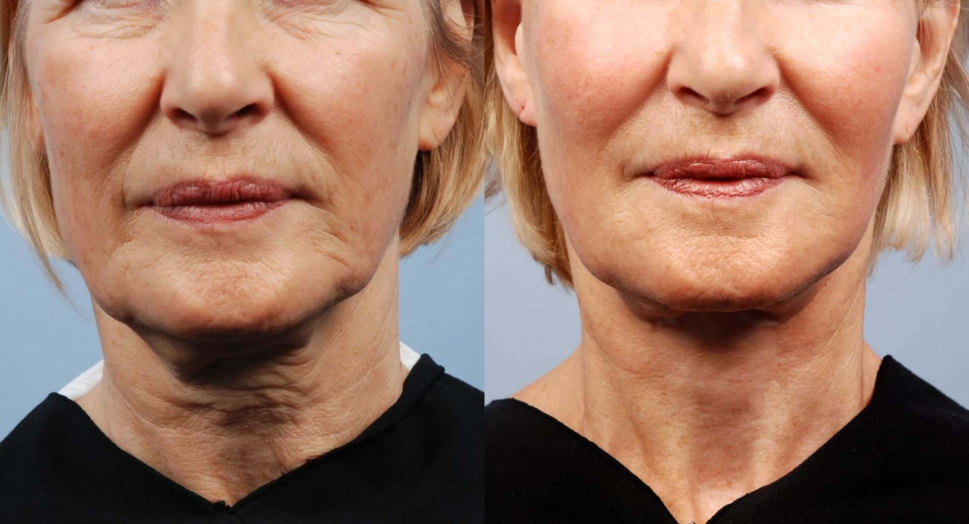 image18_non-surgical_laser-skin-treatmens_morpheus-1